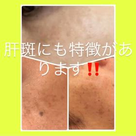 特徴に合わせて肝斑改善の画像