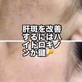 肝斑改善の画像