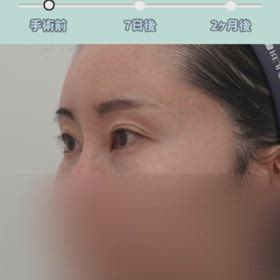 埋没、瞼の脂肪移植症例動画の画像