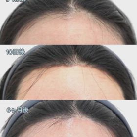 額縮小+額挙上レポ✎の画像