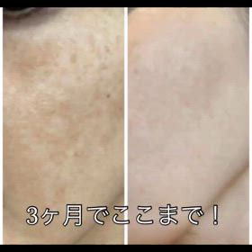 肝斑改善の画像