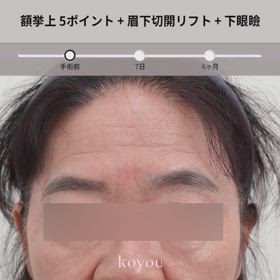 額挙上(5ポイント固定)、眉下切開、下眼瞼症例動画の画像