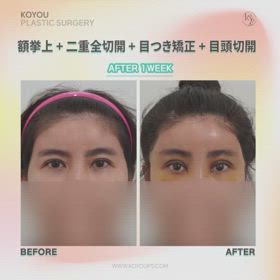 額挙上、二重全切開、目つき矯正、目頭切開症例動画の画像