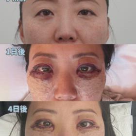 二重全切開、下眼瞼、目頭上切開症例動画の画像