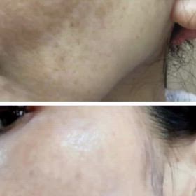 お薬ほどの成分をホームケアで肝斑改善の画像