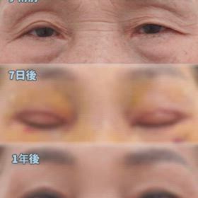 上眼瞼、目つき矯正、下眼瞼、瞼の脂肪移植の画像