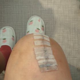 人工膝関節置換術～②入院20日目の画像