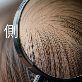 側頭部の脱毛はなんでできるんだろうの画像