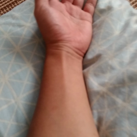 パルス治療の画像