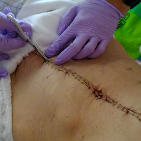 抜鉤抜糸　尿管抜去の画像