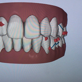 クリンチェックの画像