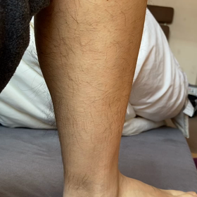 症状①：ファスキレーションの画像