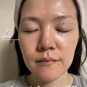 みにょん式poreless美肌ツヤ肌バージョン症例の画像