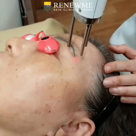 アートメイク除去の画像