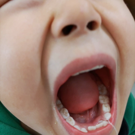 はるなり歯抜いたの画像