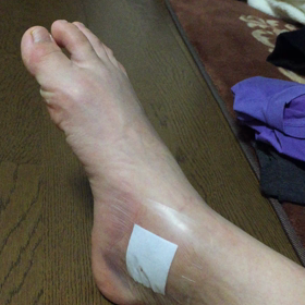 術後5日〜毎日リハビリ〜の画像