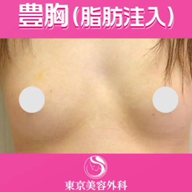 脂肪注入豊胸をされた患者様の変化をご覧ください！の画像