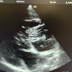 犬フィラリヤ症の画像