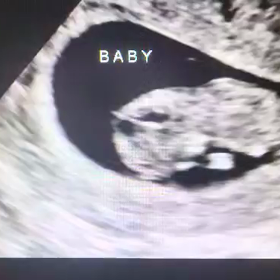 エコー写真の画像