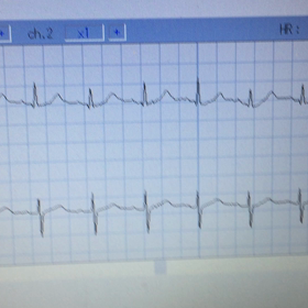 壊れている心電図の画像