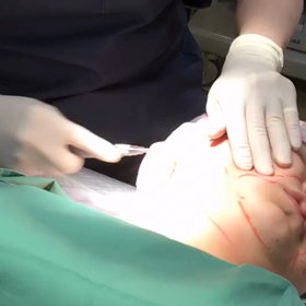 頬の脂肪吸引の動画の画像