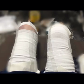 動画にしたわたしの脂肪吸引一ヶ月間の画像