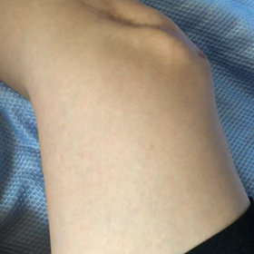 局所性痙攣の画像