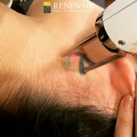 タトゥー除去の画像