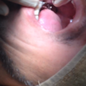 歯周病で歯がグラグラします…の画像