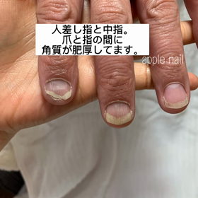 トラブル爪のケア☆apple nailの画像