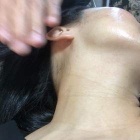 針なし水光注射キャンペーン　きゅある　きゅあ子の画像