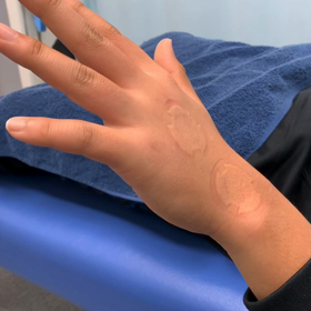 野球少年　デットボールを手の甲に受けて小指が伸びなかったけど治療後直ぐに伸びたよ。の画像