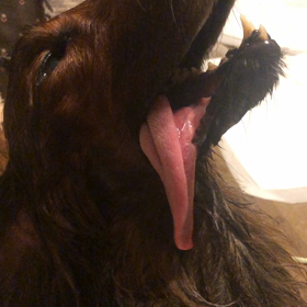 脊髄軟化症②の画像