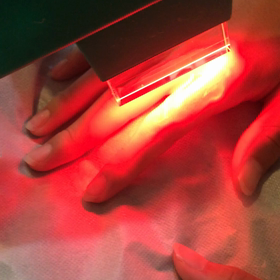 男子くんの手の指と甲の脱毛の画像