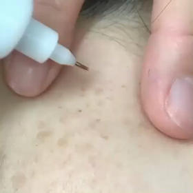 しみケア施術動画の画像