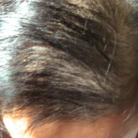 抜け毛　その後の画像