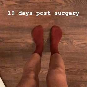 前十字靭帯損傷の手術後の回復状態の画像