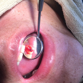 虫歯の痛みは何故？強烈に痛むのか・・・の画像