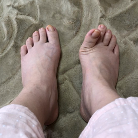 術後50日の画像