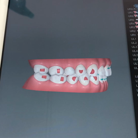 #4/10 左右のかみ合わせの画像