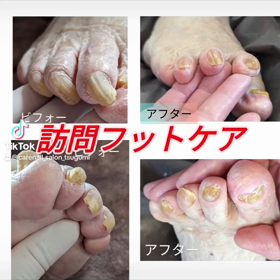 訪問フットケアの画像
