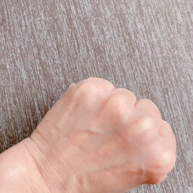 左手の伸筋腱脱臼の画像