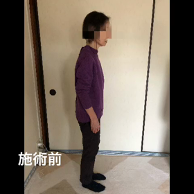 パーキンソン病の画像