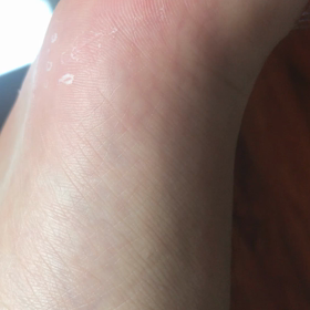 ピクつき（水虫の汚い足なので閲覧注意）の画像