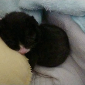 重度の漏斗胸の画像