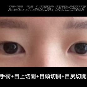 【目元整形】部分切開再手術＋目頭切開＋目上切開＋目尻切開＋タレ目形成 症例レポの画像