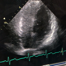 卵円孔開存　検査の画像