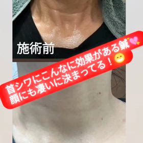美顔鍼は、金ドブ？？の画像