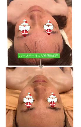 小顔マッサージつきのハーブピーリングの記事動画