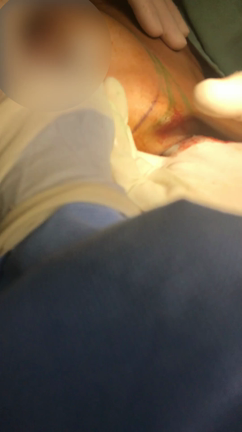 【閲覧注意】胸の注入物についての注意喚起の記事動画